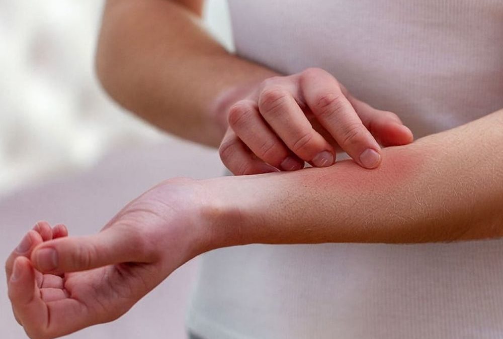 How to Treat Skin Conditions: Eczema, Seborrhea and Psoriasis