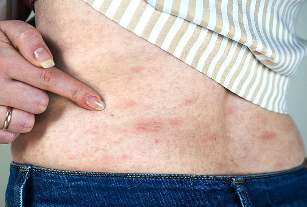 Acute and Chronic Hives and Rashes: Causes and Treatments