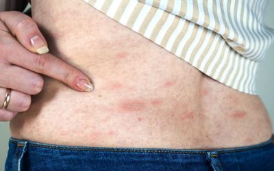 Acute and Chronic Hives and Rashes: Causes and Treatments