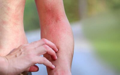 How to get rid of red, itchy heat rash